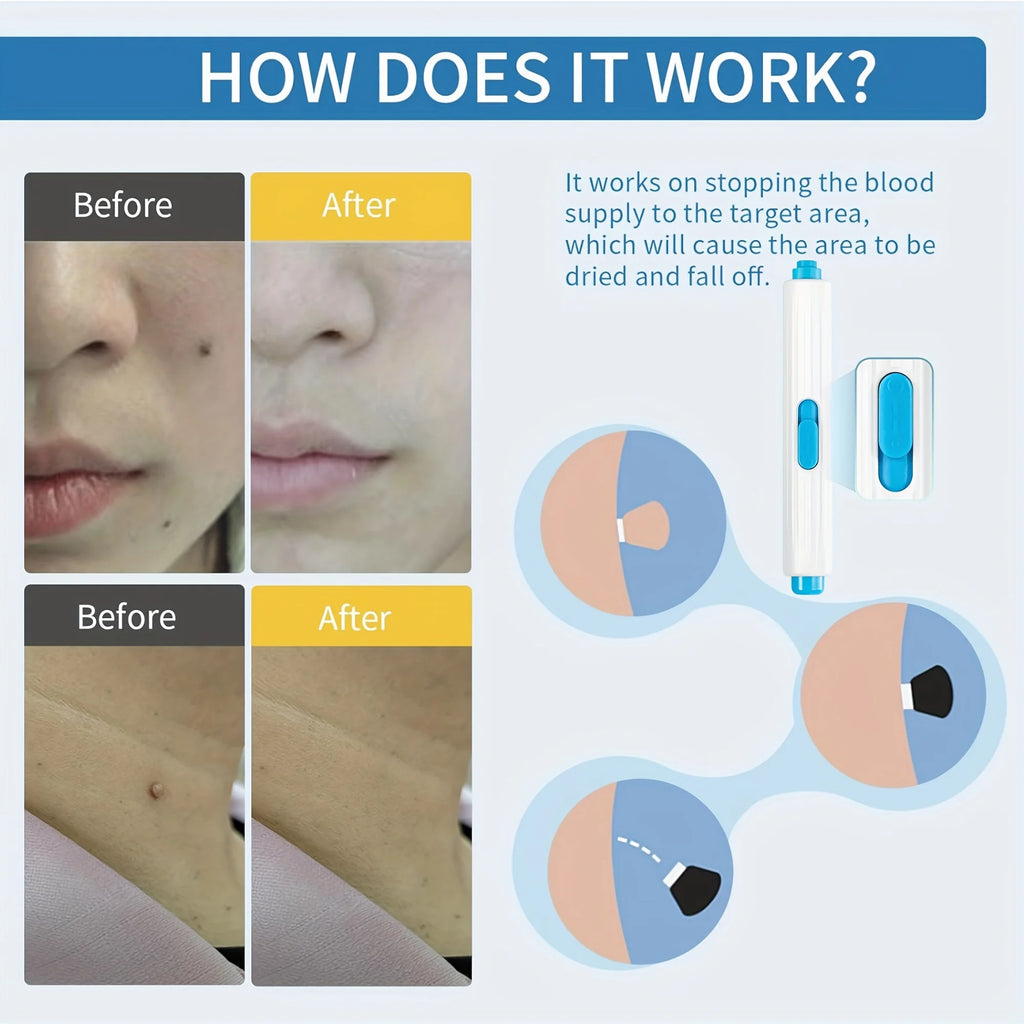 1/2/4 Pcs Removal Kit for Skin Care, One Hand User Friendly Design, Safe and Effective for Home Use